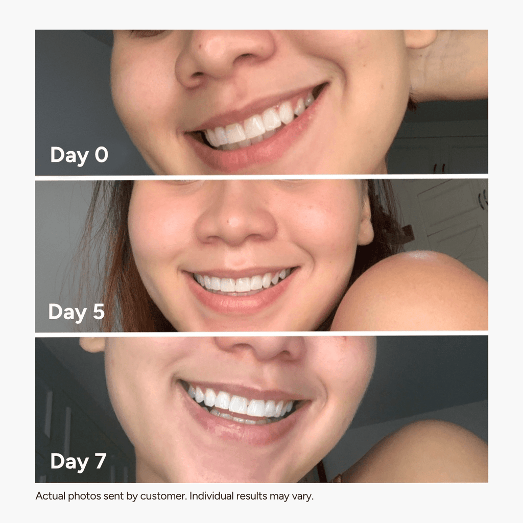 Holo Teeth Whitening Kit - Holo