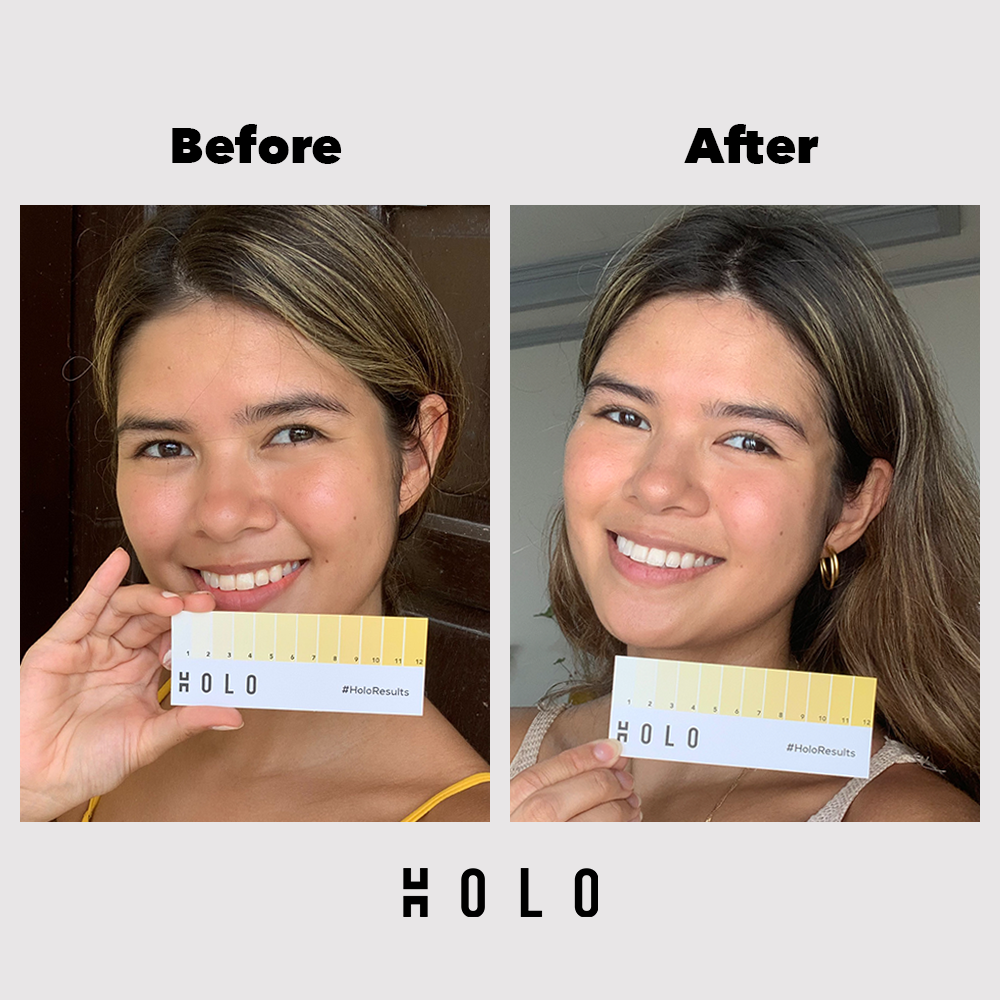 Holo Teeth Whitening Kit - Holo Teeth Whitening